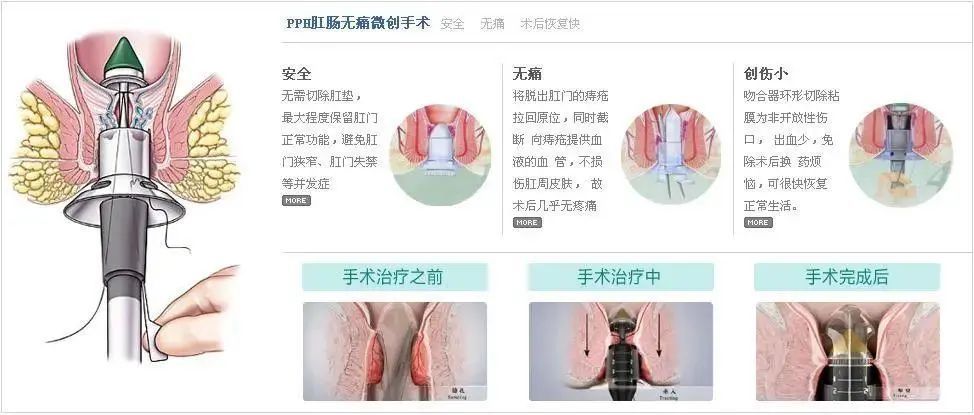 痔疮手术最新技术，科技重塑医疗之旅，引领治疗新篇章
