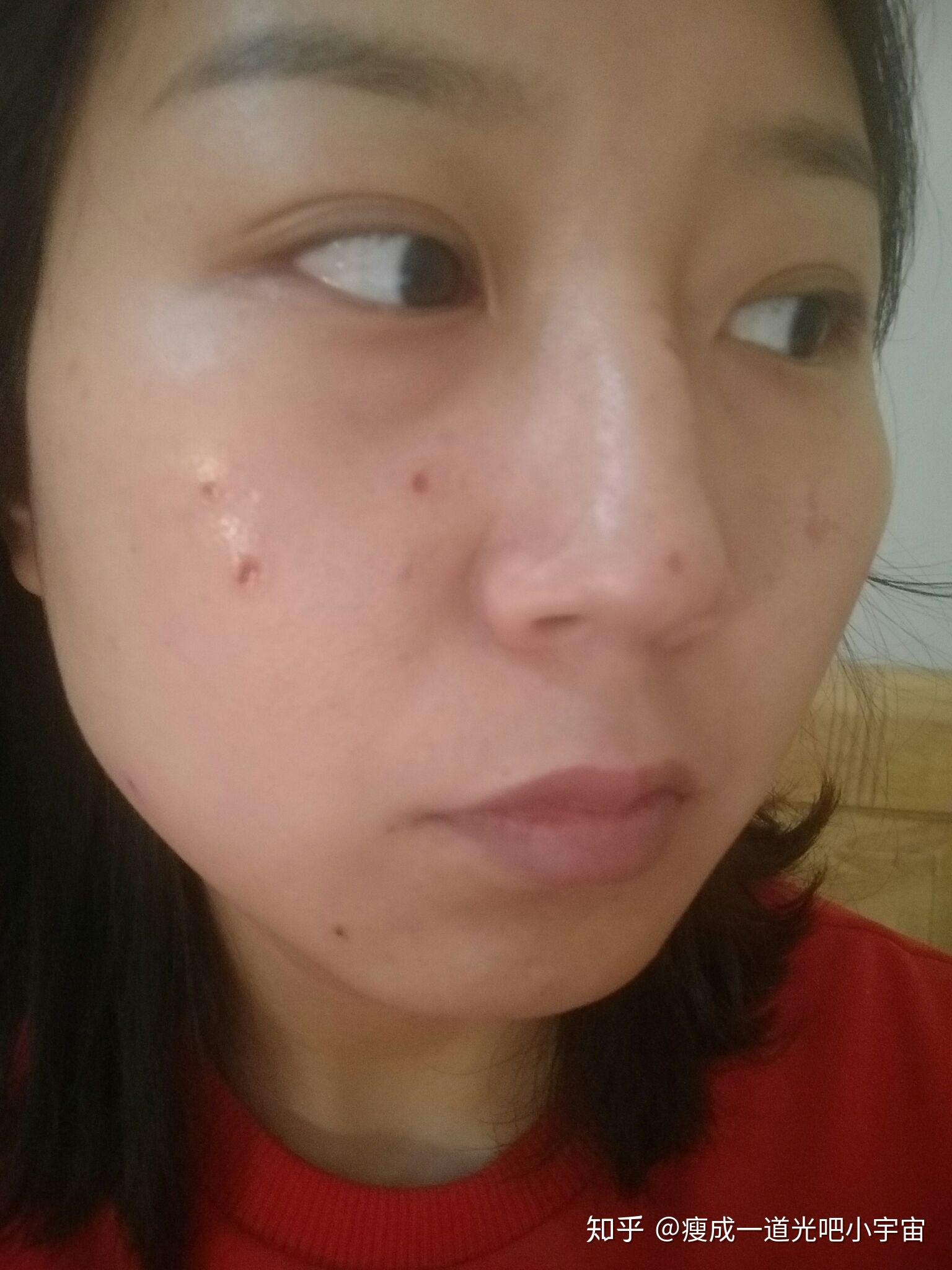 最新点痣技术揭秘，真的能够一擦就没吗？